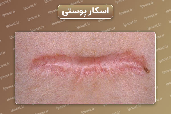Skin-scar اسکار پوستی