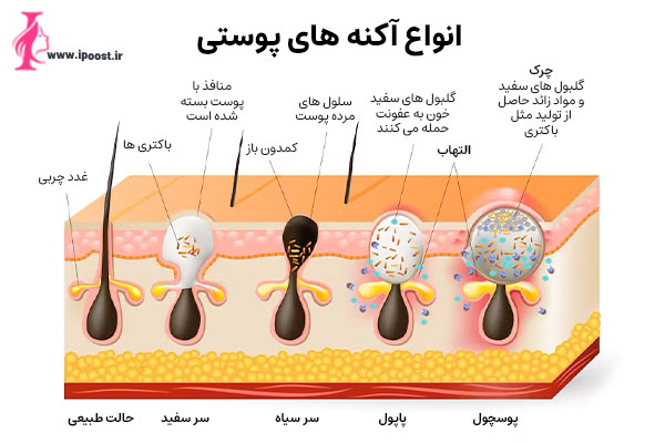 The-structure-of-acne انواع آکنه های پوستی 