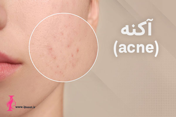 Acne-function آکنه